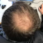 Male pattern hair loss 768x1024 1