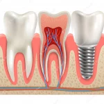 canal do dente