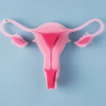 endometriose